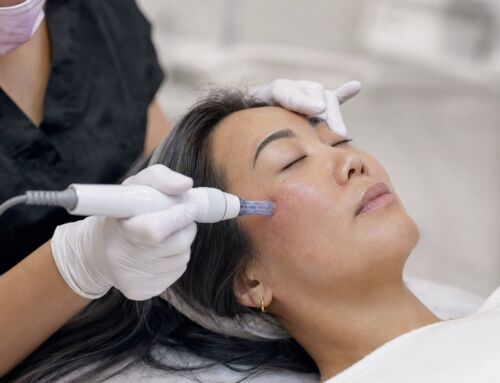 Microneedling for Face in Birmingham & Detroit: Top Benefits